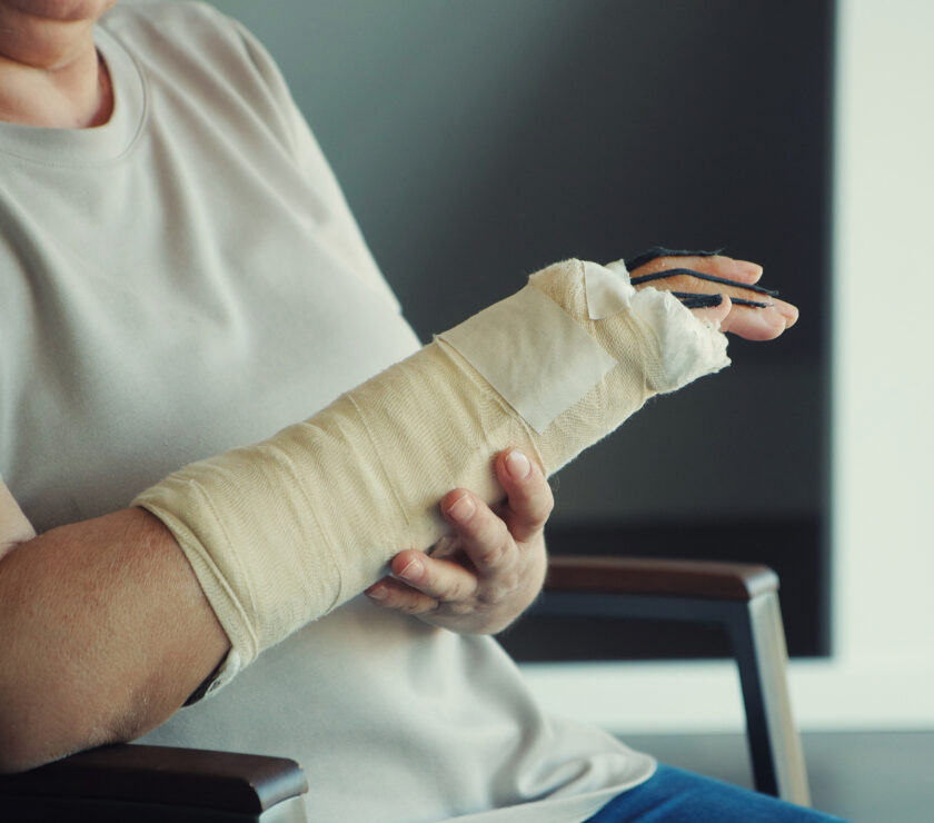 Woman with a cast on her arm and hand, recovering from injury or surgery